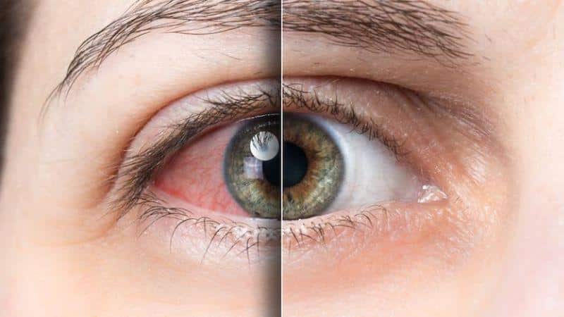 Mắt ở trạng thái bình thường và tình trạng khô mắt do ảnh hưởng từ chức năng của tuyến lệ